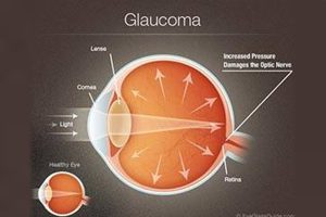 Medical illustration of an eye with glaucoma showing increased intraocular pressure damaging the optic nerve