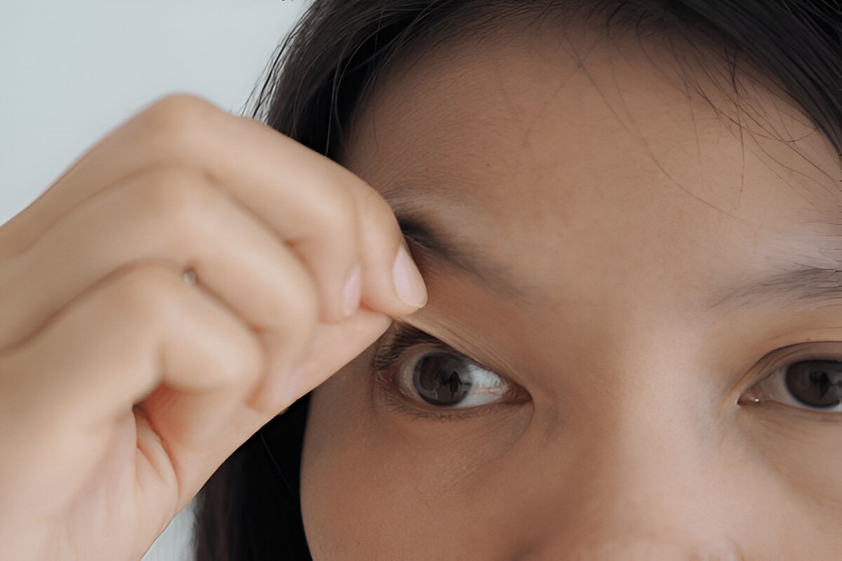 Causes Bulging Eyes Thyroid Eye Disease