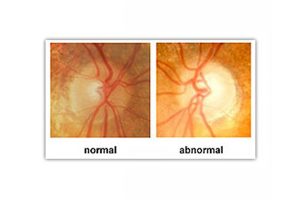 Side-by-side images comparing a healthy optic nerve with one showing signs of abnormality, labeled “normal” and “abnormal"
