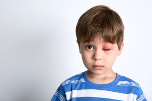 Causes and treatment for pink, stinging eyes