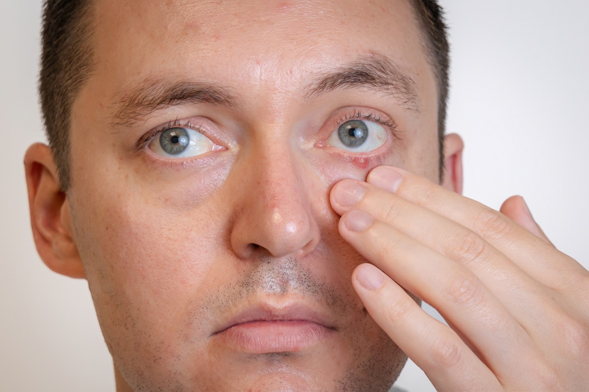 Best Itchy Eyes Treatment Options